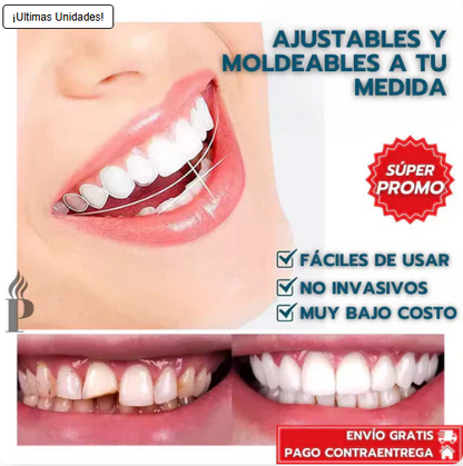Carillas Dentales