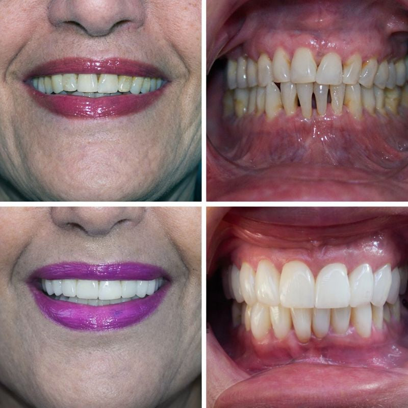 Carillas Dentales
