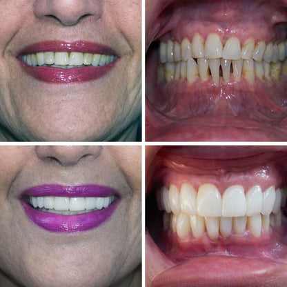 Carillas Dentales