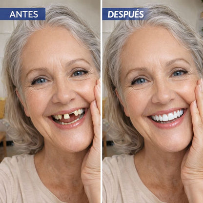 Carillas Dentales